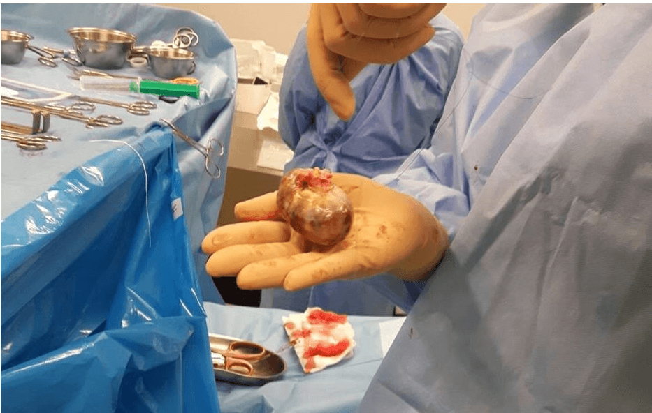 Comunicat. Medicii Spitalului de Cardiologie Clinicco au descoperit și extirpat o tumoră de mărimea unui ou în inima unei paciente!