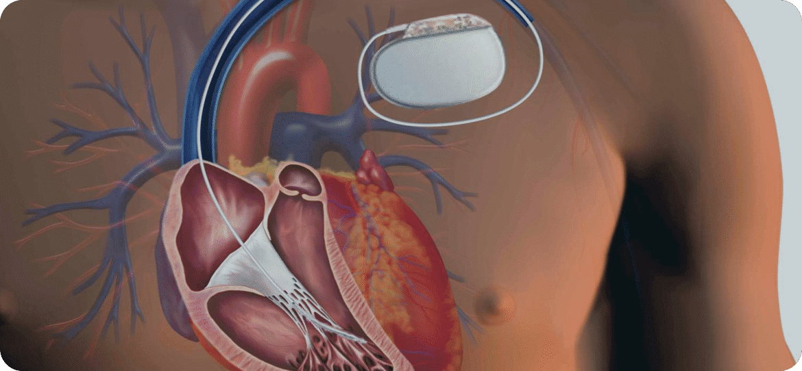 Four patients at Clinicco Hospital have benefited from the most user-friendly and long-lasting pacemaker implant