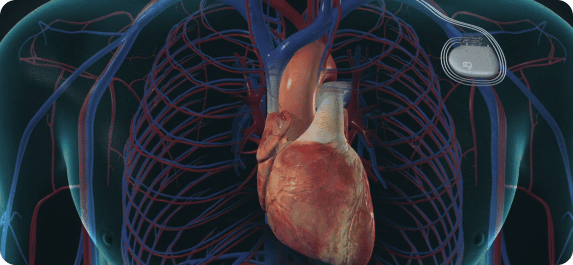 Heart pacemakers covered by the National Heart Disease Program